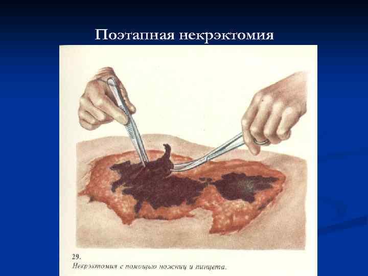 Поэтапная некрэктомия 
