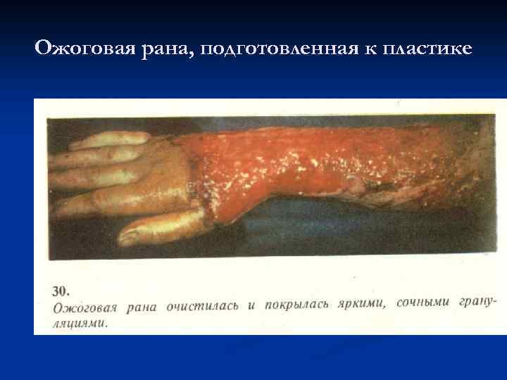 Ожоговая рана, подготовленная к пластике 