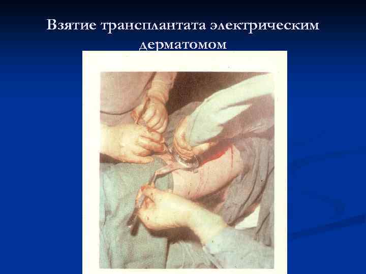 Взятие трансплантата электрическим дерматомом 