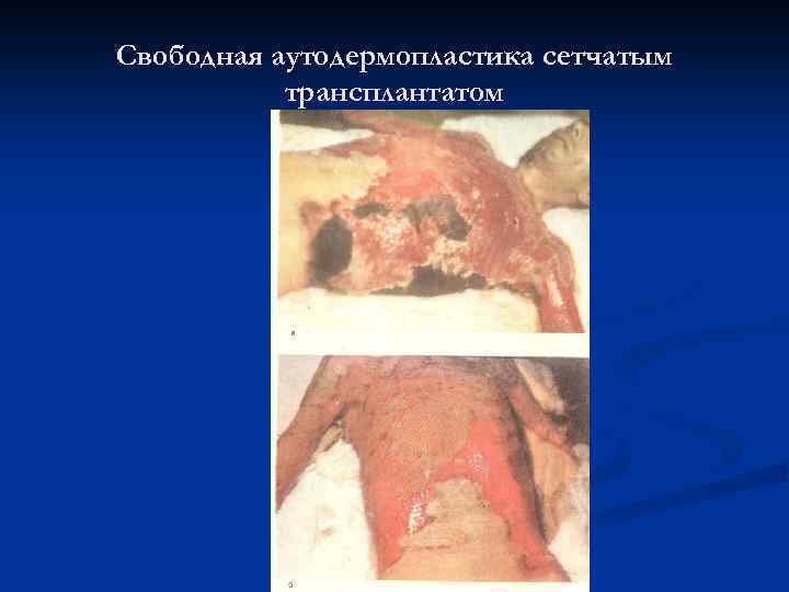 Свободная аутодермопластика сетчатым трансплантатом 