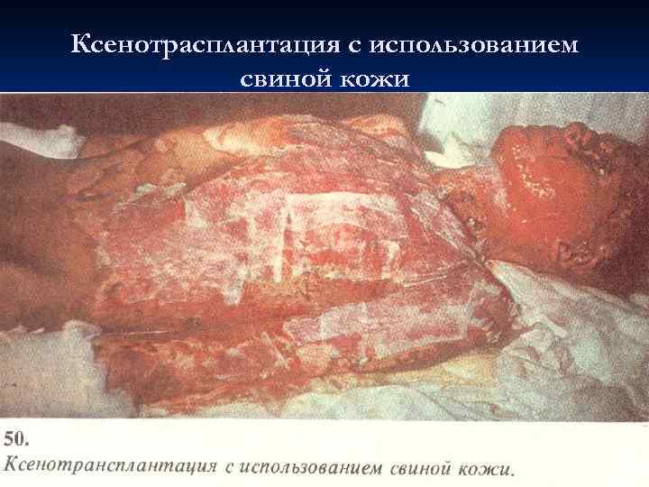 Ксенотрасплантация с использованием свиной кожи 