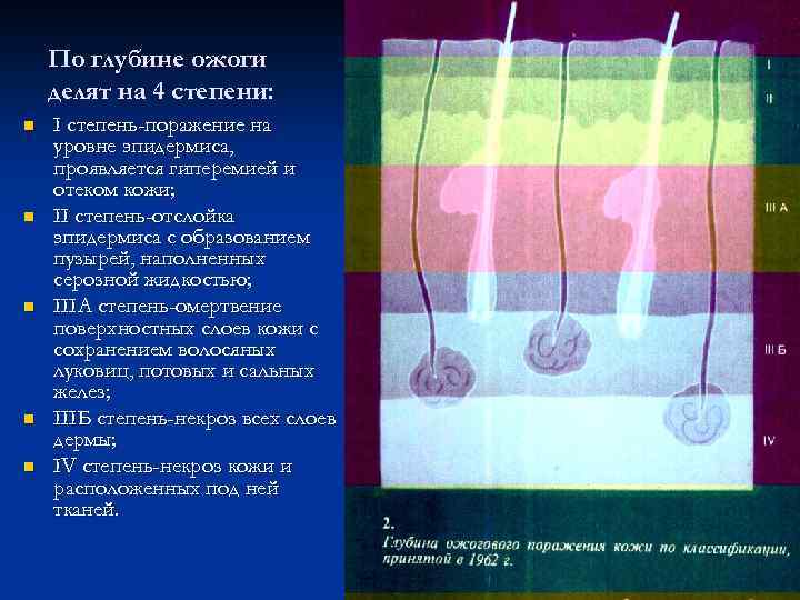 По глубине ожоги делят на 4 степени: n n n I степень-поражение на уровне