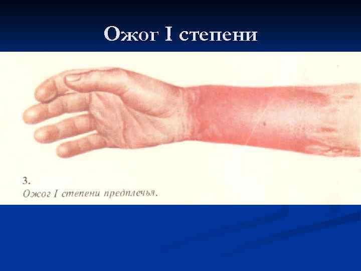 Ожог I степени 