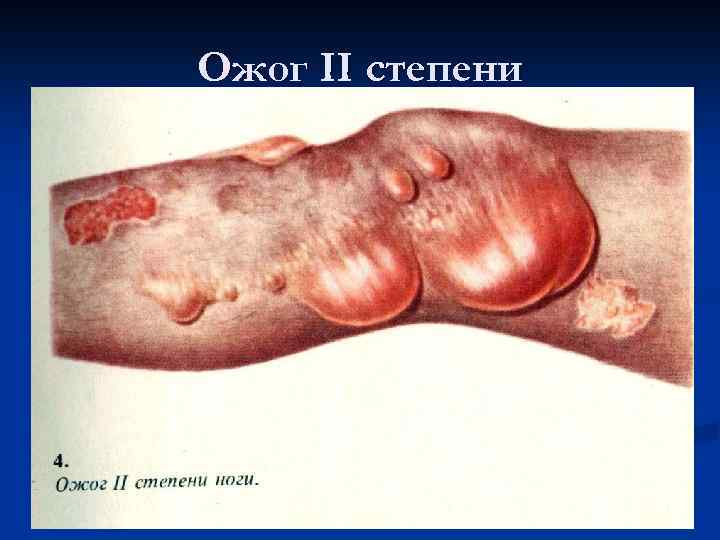 Ожог II степени 