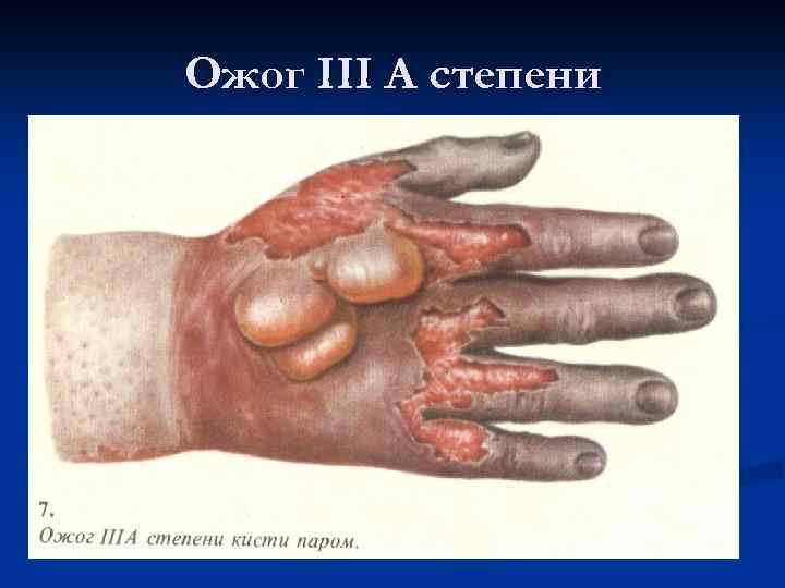 Ожог III A степени 
