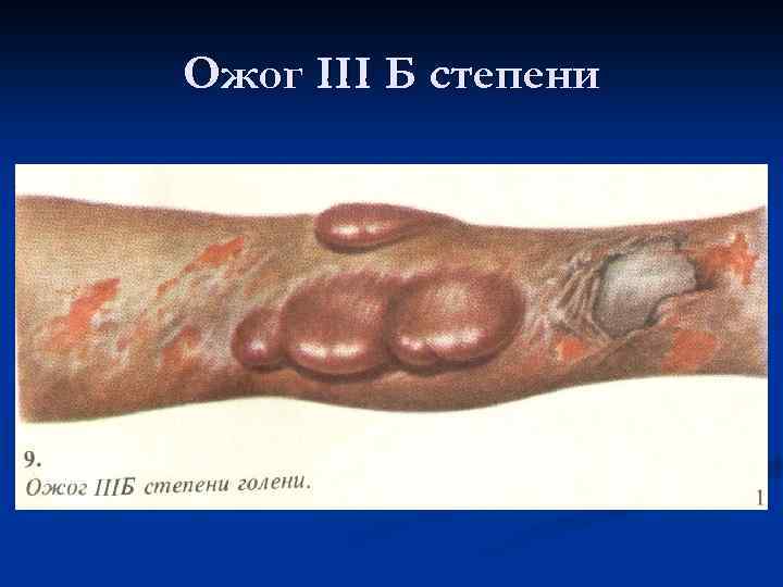 Ожог III Б степени 