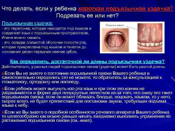 Что делать, если у ребенка короткая подъязычная уздечка? Подрезать ее или нет? Подъязычная уздечка: