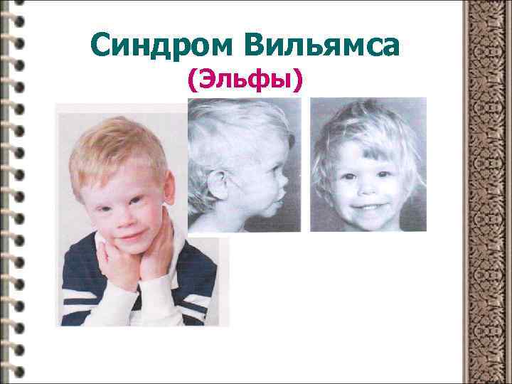 Синдром Вильямса (Эльфы) 