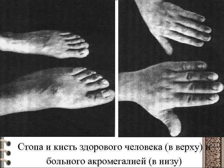 Стопа и кисть здорового человека (в верху) и больного акромегалией (в низу) 