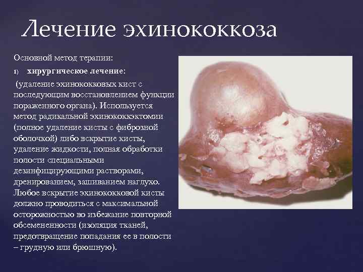 Лечение эхинококкоза Основной метод терапии: 1) хирургическое лечение: (удаление эхинококковых кист с последующим восстановлением