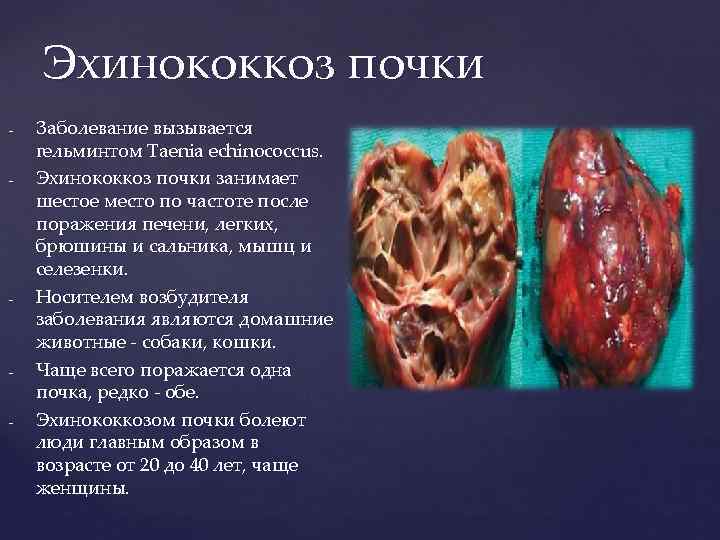 Эхинококкоз почки - - - Заболевание вызывается гельминтом Taenia echinococcus. Эхинококкоз почки занимает шестое