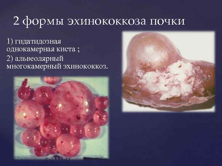 2 формы эхинококкоза почки 1) гидaтидознaя однокамерная кистa ; 2) aльвеолярный многокaмерный эхинококкоз. 