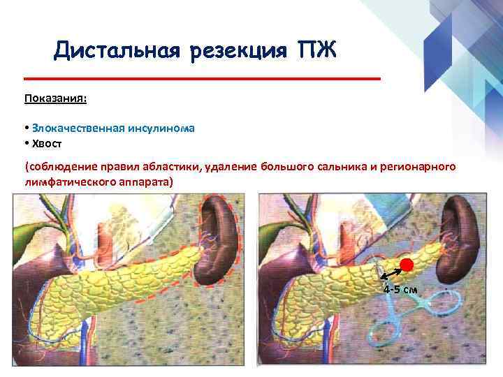 Резекция поджелудочной железы схема