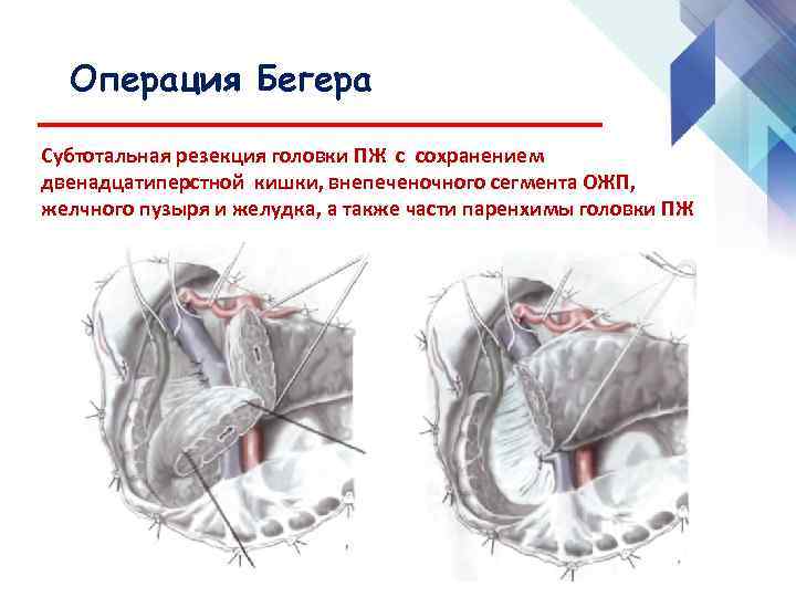 Операция Бегера Субтотальная резекция головки ПЖ с сохранением двенадцатиперстной кишки, внепеченочного сегмента ОЖП, желчного