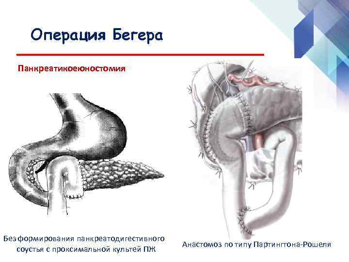 Анастомоз по брауну схема