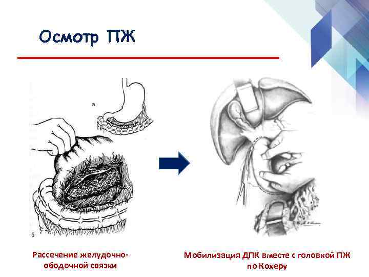Осмотр ПЖ Рассечение желудочноободочной связки Мобилизация ДПК вместе с головкой ПЖ по Кохеру 