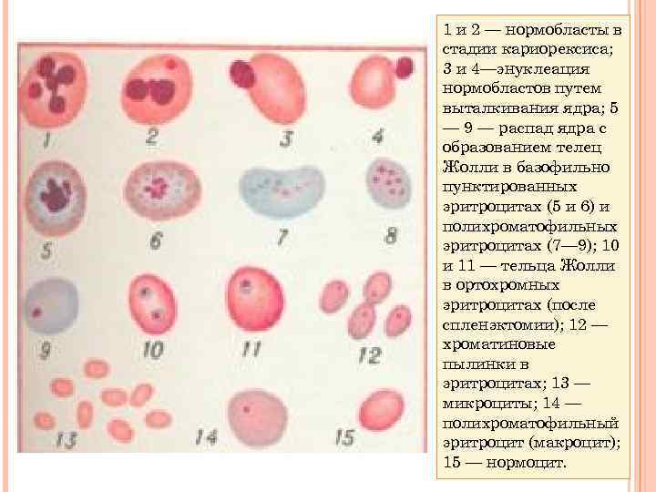 Нормобласты. Нормобласты Хроматофильные. Нормобласты в крови. Нормоциты в крови. Появление нормобластов в периферической крови.