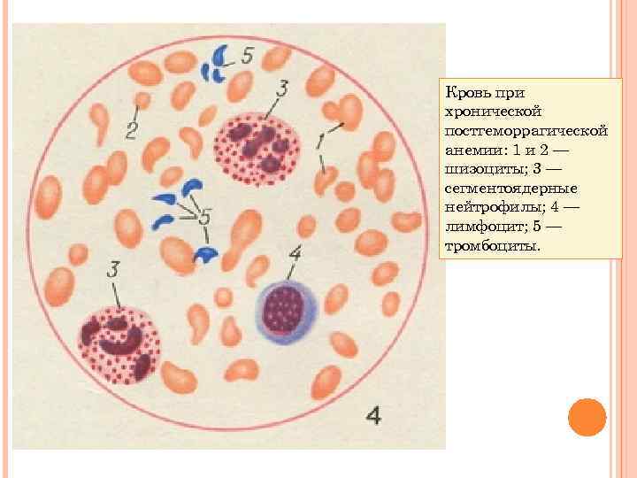 Кровь при хронической постгеморрагической анемии: 1 и 2 — шизоциты; 3 — сегментоядерные нейтрофилы;