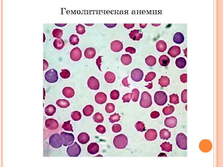 Тельце гейнца. Гемолитическая анемия картина крови. Гемолитическая анемия мазок крови. Аутоиммунная гемолитическая анемия картина крови. Аутоиммунная гемолитическая анемия мазок.