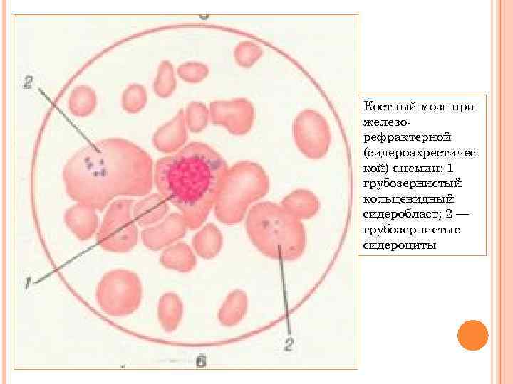 Костный мозг при железорефрактерной (сидероахрестичес кой) анемии: 1 грубозернистый кольцевидный сидеробласт; 2 — грубозернистые