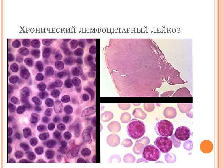 Картина крови хронического лимфолейкоза