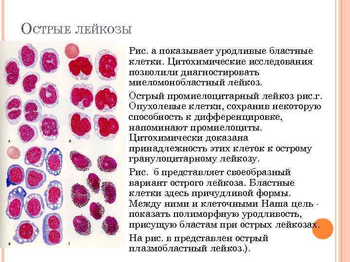 ОСТРЫЕ ЛЕЙКОЗЫ Рис. а показывает уродливые бластные клетки. Цитохимические исследования позволили диагностировать миеломонобластный лейкоз.