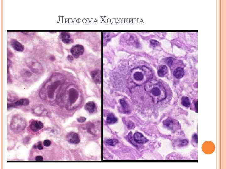 Цитологическая картина лимфомы ходжкина