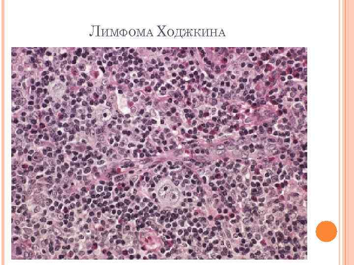 Цитологическая картина лимфомы ходжкина