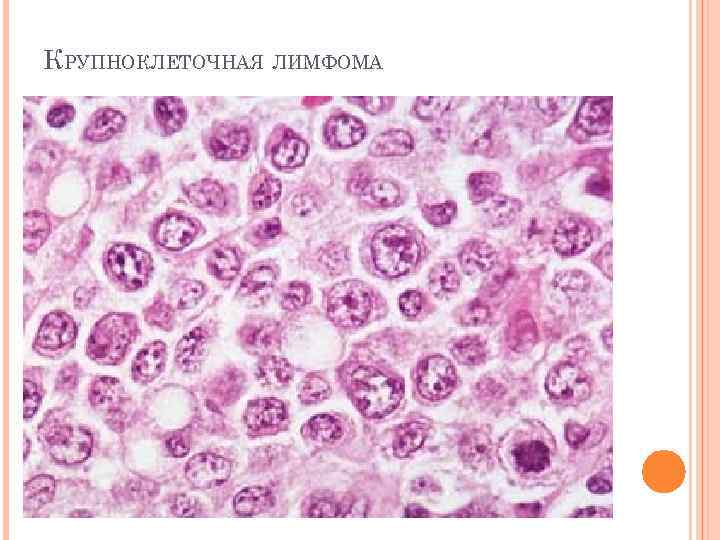 Медиастинальная в крупноклеточная лимфома