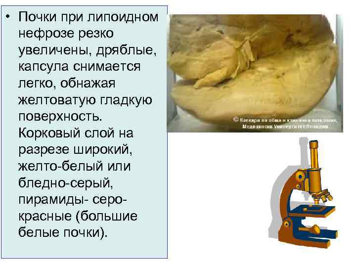  • Почки при липоидном нефрозе резко увеличены, дряблые, капсула снимается легко, обнажая желтоватую