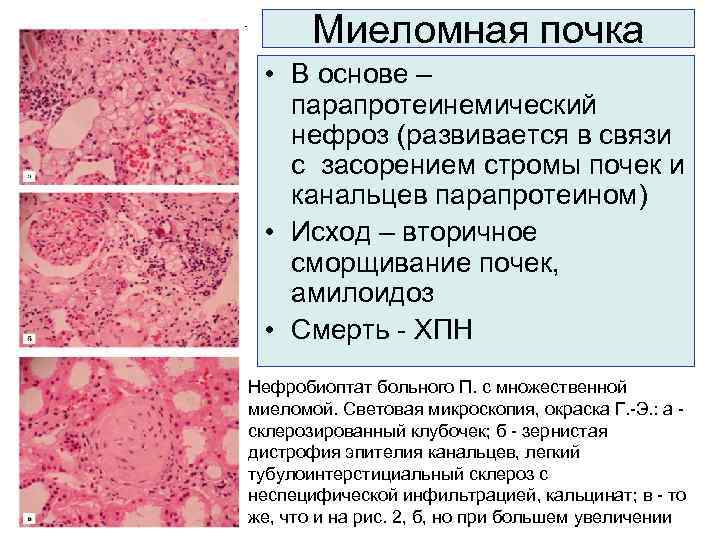 Миеломная почка • В основе – парапротеинемический нефроз (развивается в связи с засорением стромы