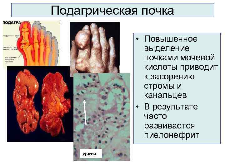 Болезни почек у детей презентация