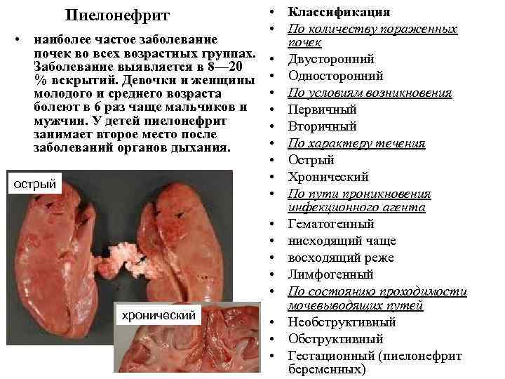 Картинки заболевания почек