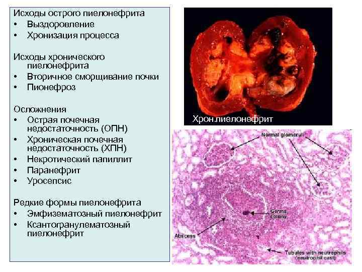 Картинки заболевания почек