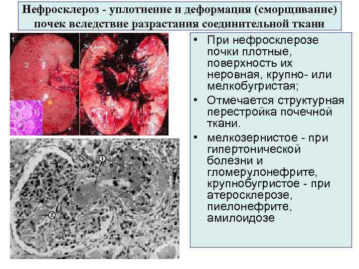Нефросклероз - уплотнение и деформация (сморщивание) почек вследствие разрастания соединительной ткани • При нефросклерозе