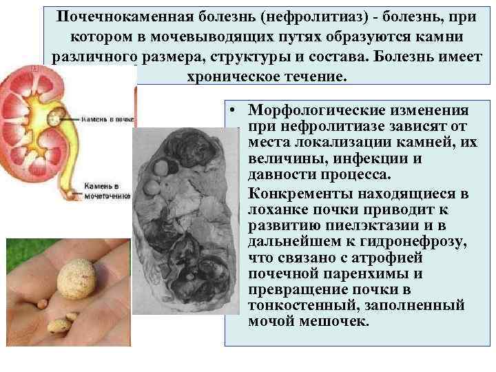 Почечнокаменная болезнь (нефролитиаз) - болезнь, при котором в мочевыводящих путях образуются камни различного размера,
