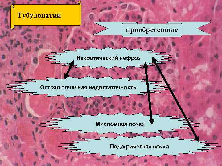 Тубулопатии приобретенные Некротический нефроз Острая почечная недостаточность Миеломная почка Подагрическая почка 