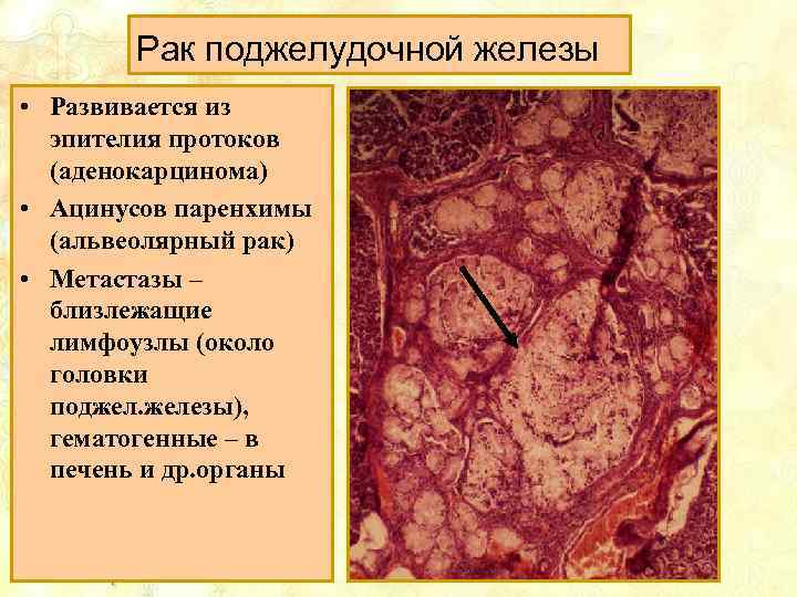 Рак поджелудочной железы • Развивается из эпителия протоков (аденокарцинома) • Ацинусов паренхимы (альвеолярный рак)