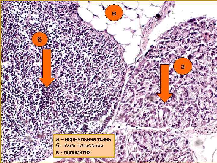 в б а а – нормальная ткань б – очаг нагноения в - липоматоз