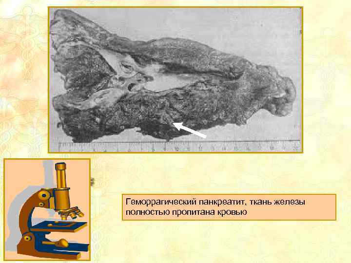 Геморрагический панкреатит, ткань железы полностью пропитана кровью 