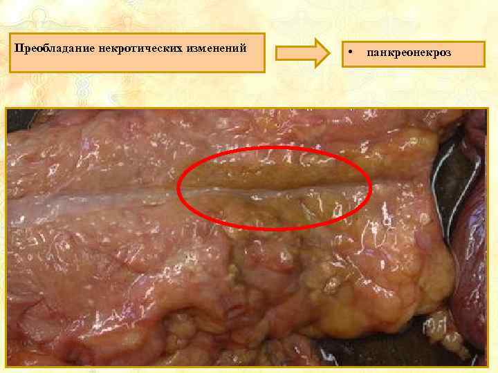 Преобладание некротических изменений • панкреонекроз 