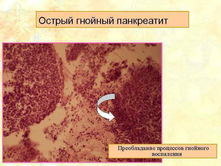 Острый гнойный панкреатит Преобладание процессов гнойного воспаления 