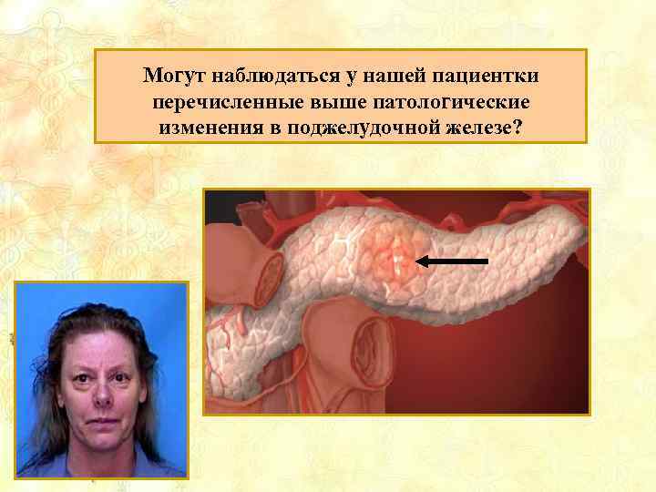 Могут наблюдаться у нашей пациентки перечисленные выше патологические изменения в поджелудочной железе? 