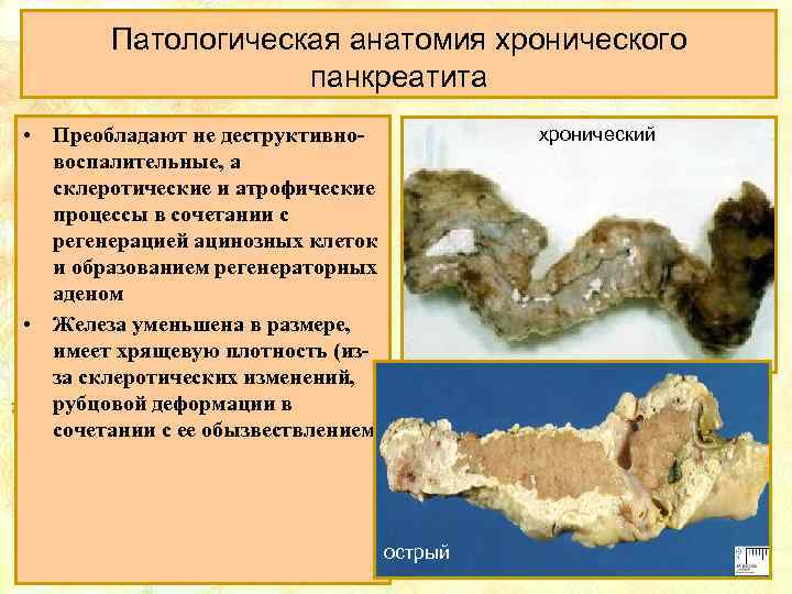 Патологическая анатомия хронического панкреатита • Преобладают не деструктивновоспалительные, а склеротические и атрофические процессы в