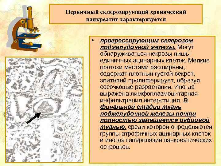 Первичный склерозирующий хронический панкреатит характеризуется • прогрессирующим склерозом поджелудочной железы. Могут обнаруживаться некрозы лишь