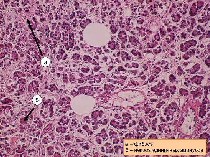 а б а – фиброз б – некроз единичных ацинусов 