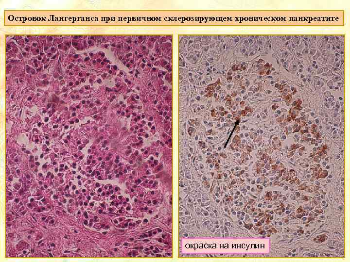 Островок Лангерганса при первичном склерозирующем хроническом панкреатите окраска на инсулин 