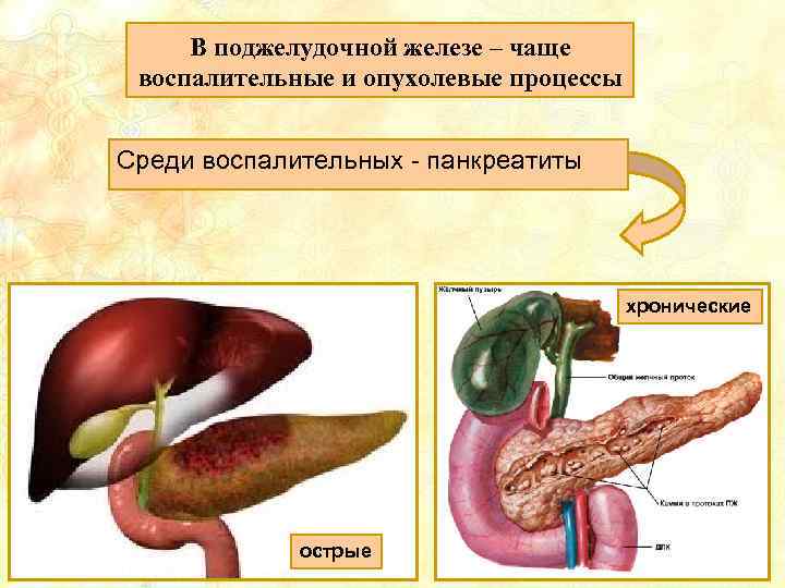 В поджелудочной железе – чаще воспалительные и опухолевые процессы Среди воспалительных - панкреатиты хронические