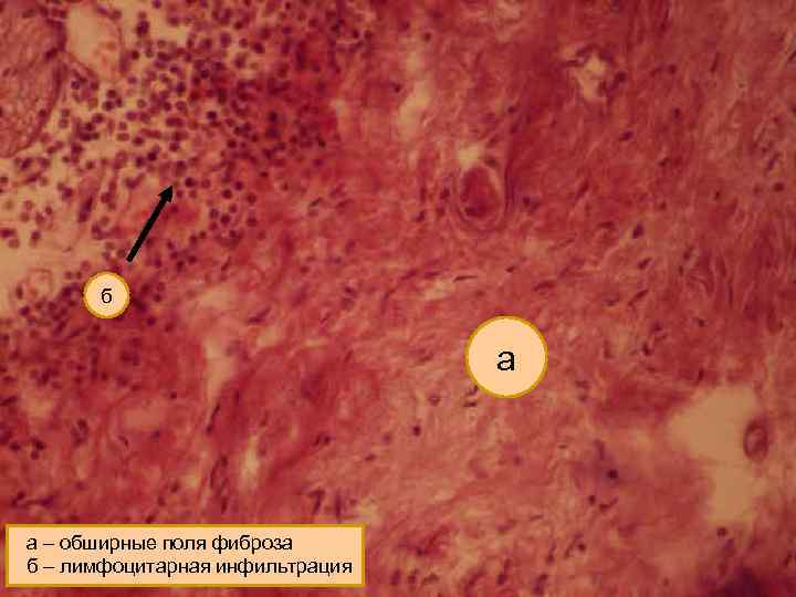 б а а – обширные поля фиброза б – лимфоцитарная инфильтрация 