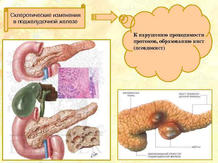 Склеротические изменения в поджелудочной железе К нарушению проходимости протоков, образованию кист (псевдокист) 